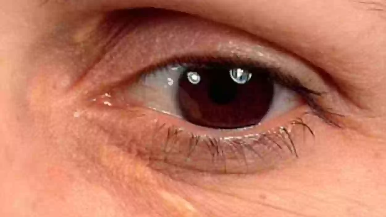علامات تظهر في العين تدل على الإصابة بارتفاع في الكوليسترول